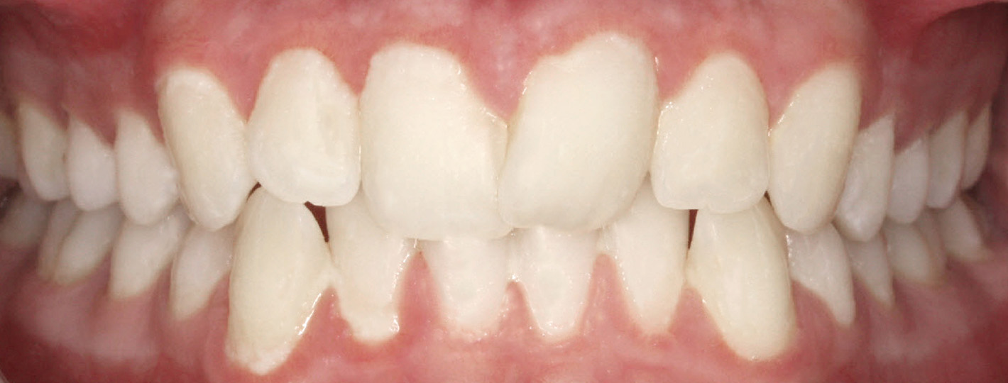 crowding-teeth-before
