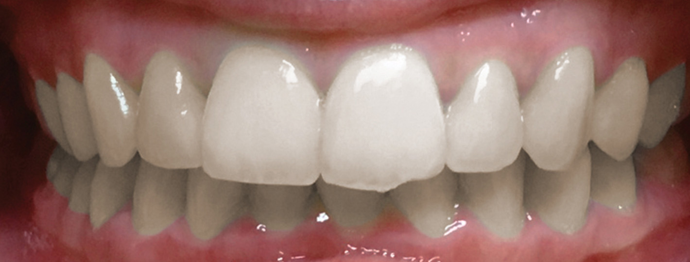 overbite-teeth-before